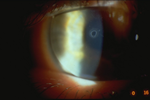 Central Corneal Erosion
