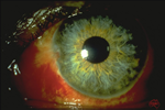 Conjunctival Haemorrhage