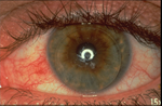 Conjunctival Injection