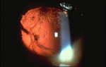Corneal Scarring and Vascularization