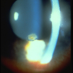 Corneal Ulcer