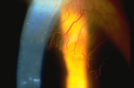 Corneal Vascularization
