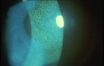 Diffuse Staining Due to Toxicity Reaction