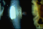 Endothelial Guttata
