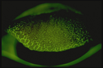 Follicles on Tarsal Conjunctiva Fluorescein