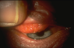 Giant Papillary Conjunctivitis