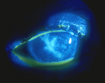 Herpes Keratitis