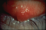 Internal Hordeolum