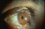 Keratoglobus