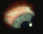 Limbal Hyperaemia