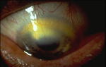 Lipid Keratopathykeratocnus and Vascularization Left Eye