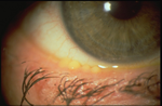 Meibomian Gland Dysfunction