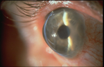Pellucid Marginal Corneal Degeneration