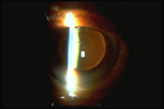 Pseudoexfoliative Glaucoma