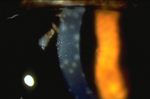 Subepithelial Corneal Infiltrates