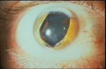 A Visual Affair Optometry Arlington Traumatic Aniridia