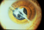 Traumatic Lesion