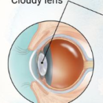 Cataract Surgery from a Patients Viewpoint