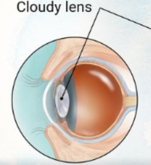 Cataracts